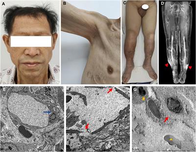Chronic systemic capillary leak syndrome with lymphatic capillaries involvement and MYOF mutation: case report and literature review